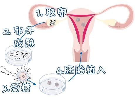 染色体易位案例